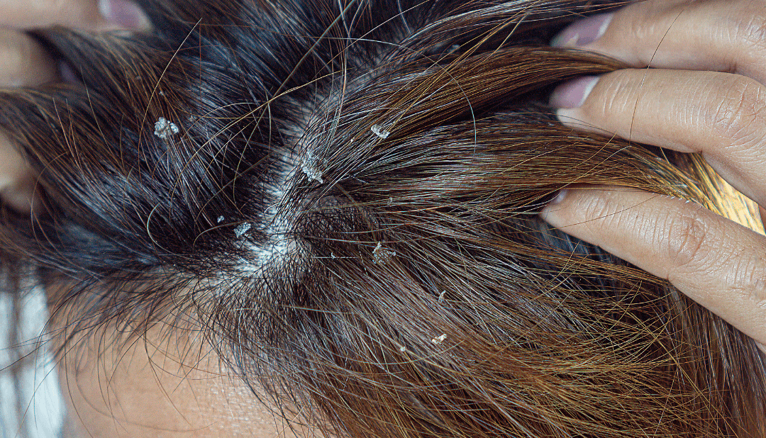 Seborrheic Dermatitis: Causes, Symptoms & How I Treated My Flaky, Irritated Scalp Without a Doctor