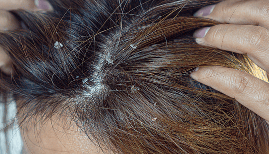 Seborrheic Dermatitis: Causes, Symptoms & How I Treated My Flaky, Irritated Scalp Without a Doctor